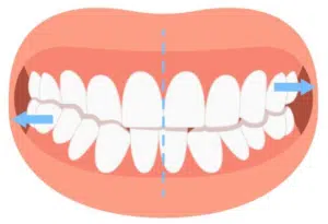 Crossbite