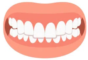 Overbite