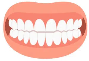Underbite