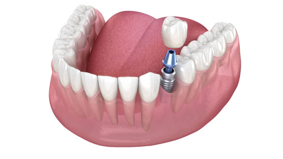 Abutment Placement